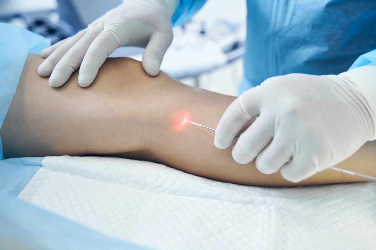 Sonde laser endoveineux
